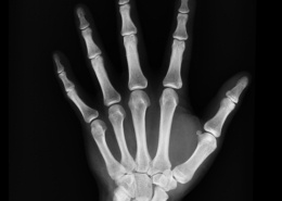 artrose van de hand