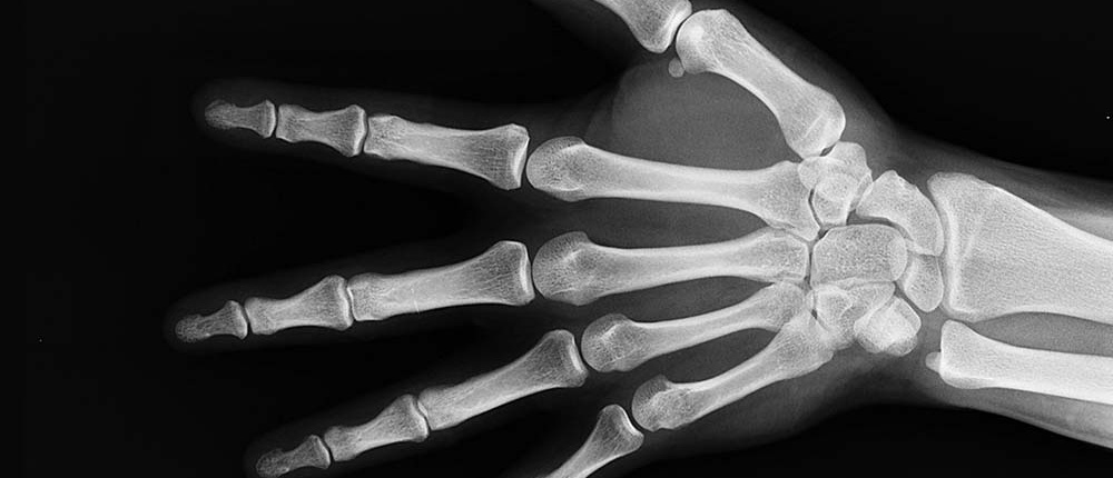 Onverklaarbare pijn of stijfheid in je handen? Mogelijk heb je last van artrose aan je hand. Fonkelzorg informeert je over wat je kan doen om de pijn te verminderen.
